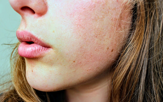 Close-up of a woman’s dehydrated face, how to repair skin.